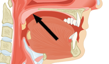 Intro to the Soft Palate
